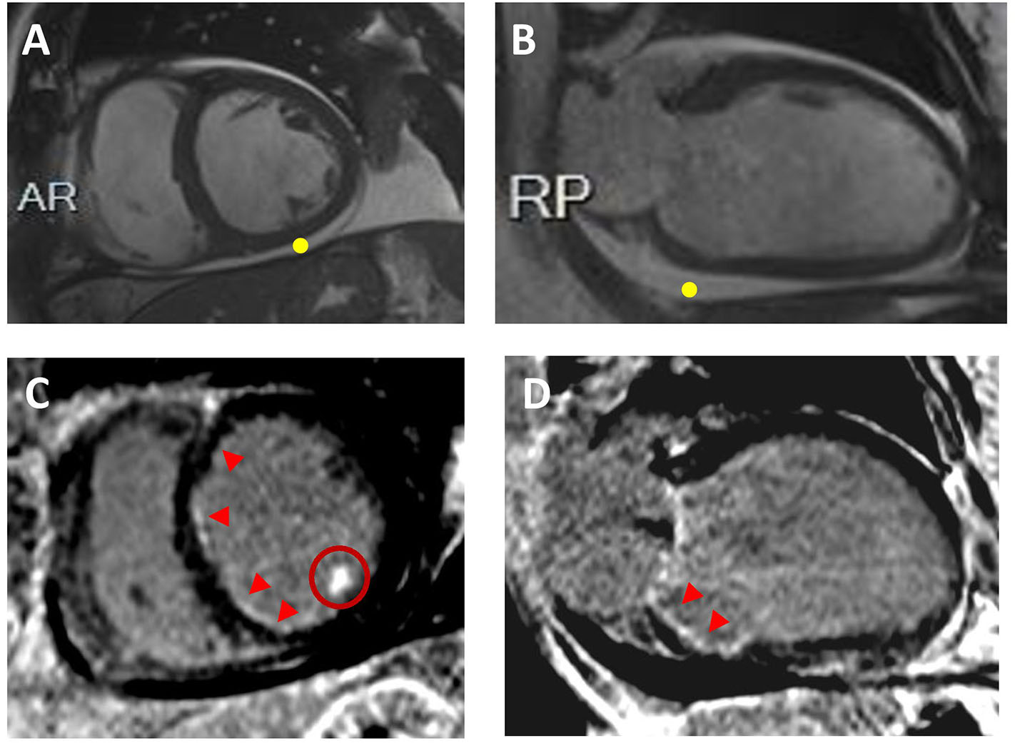 原始文獻 Figure 3：實際 ischemic cardiomyopathy 的 CMR cine 及 subendocardial LGE
