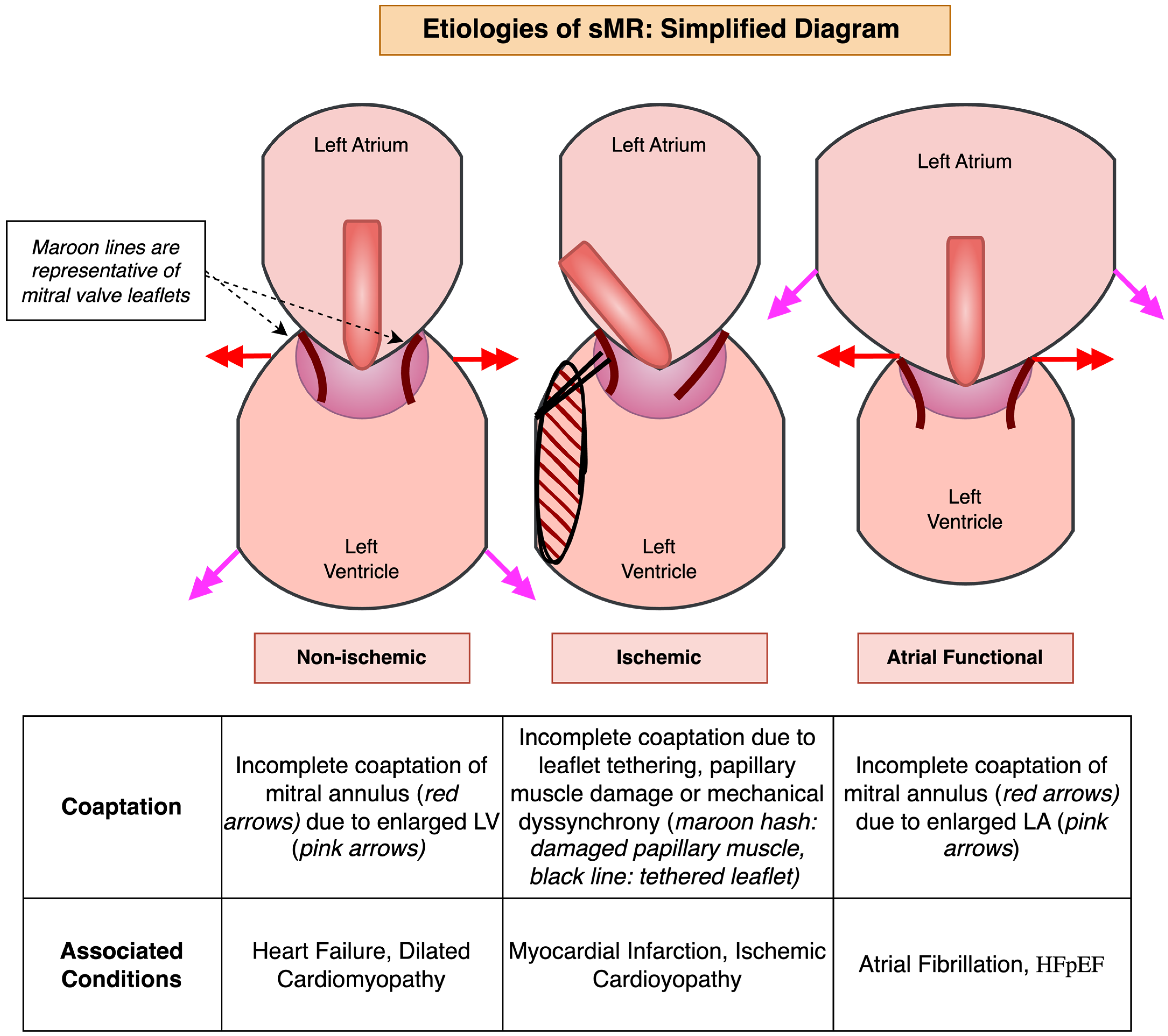 文獻原始 Figure 1：非缺血性 ventricular secondary、ischemic secondary 與 atrial functional MR 的不同解剖機轉